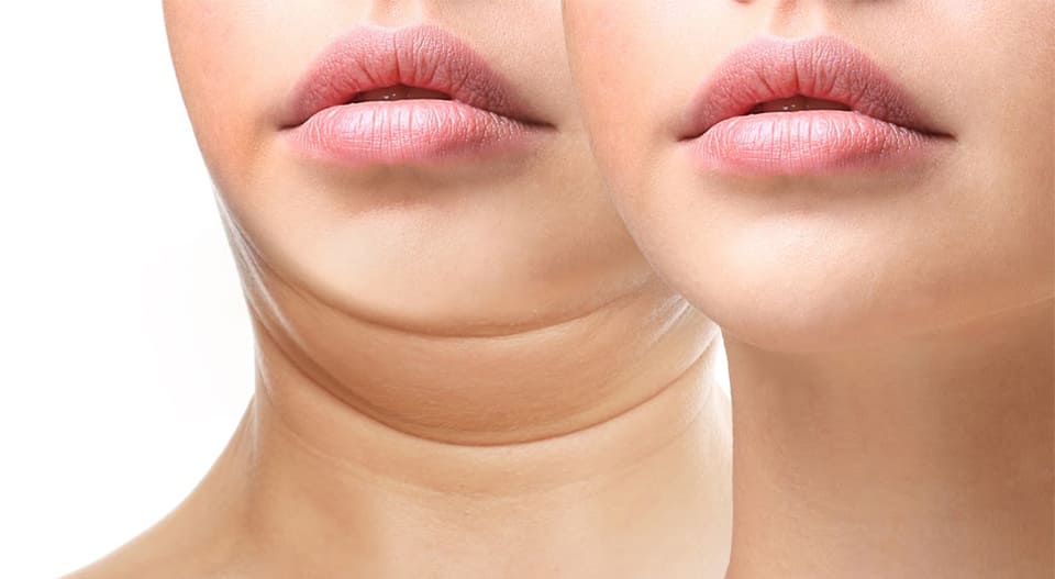 Lipolaser