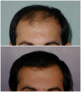 Trapianto capelli Prima Dopo foto risultati autotrapianto capelli tecnica fue