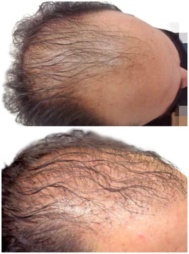 Trapianto capelli Prima e Dopo