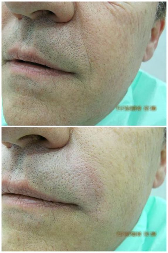 Filler Acido Ialuronico riempimento rughe viso Prima e Dopo