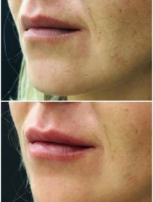 Filler Labbra Prima e Dopo