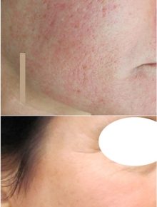 Laserterapia Laser frazionato e CO2 Cicatrici Acne Prima e Dopo