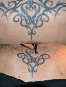 Laserterapia Laser Q-Switch Rimozione tatuaggi Prima Subito Dopo