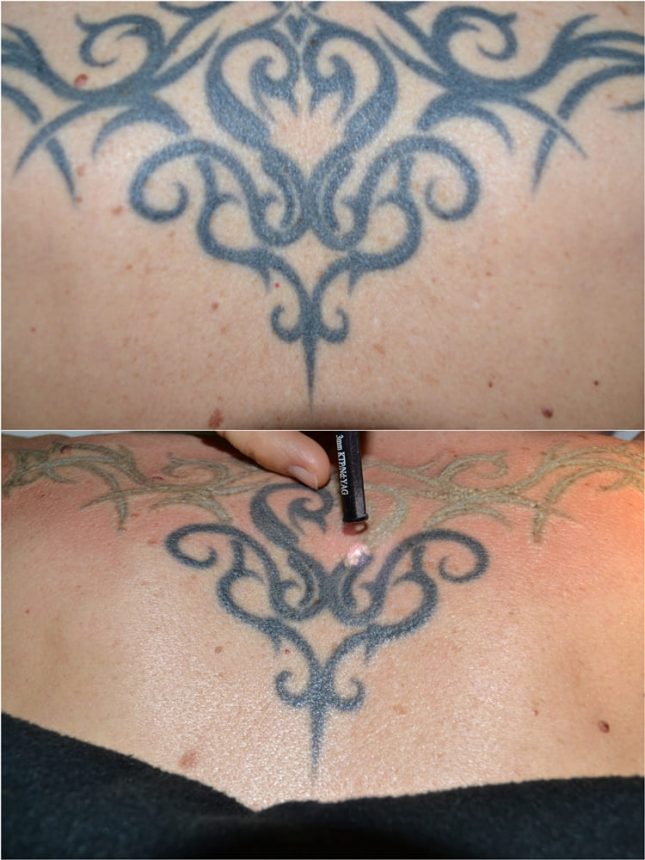 Laserterapia Laser Q-Switch Rimozione tatuaggi Prima Subito Dopo