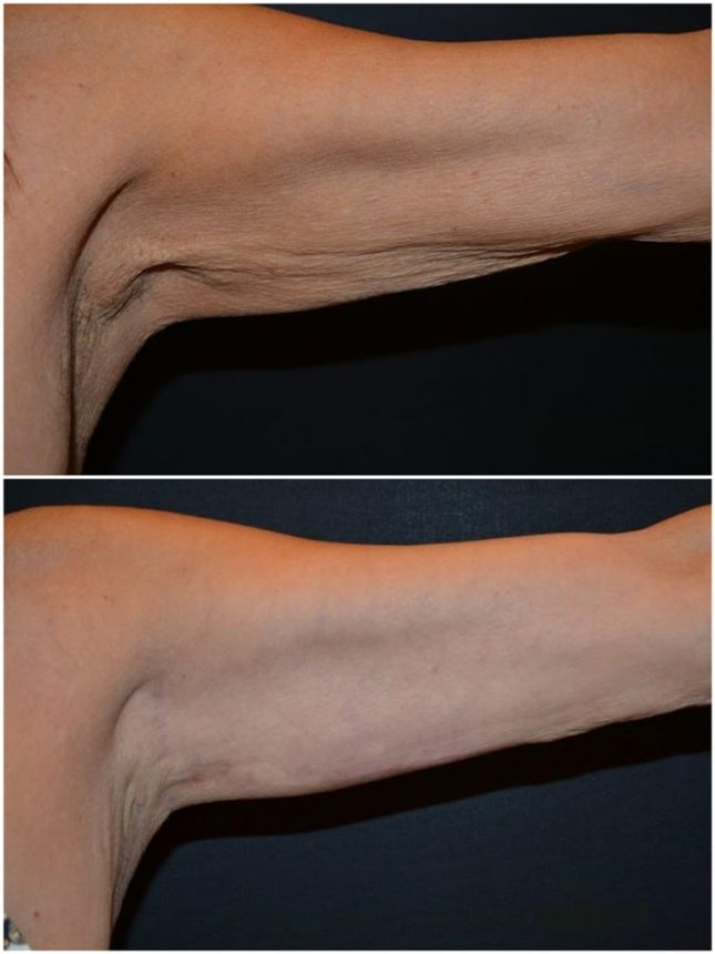 Lifting Braccia Prima e Dopo
