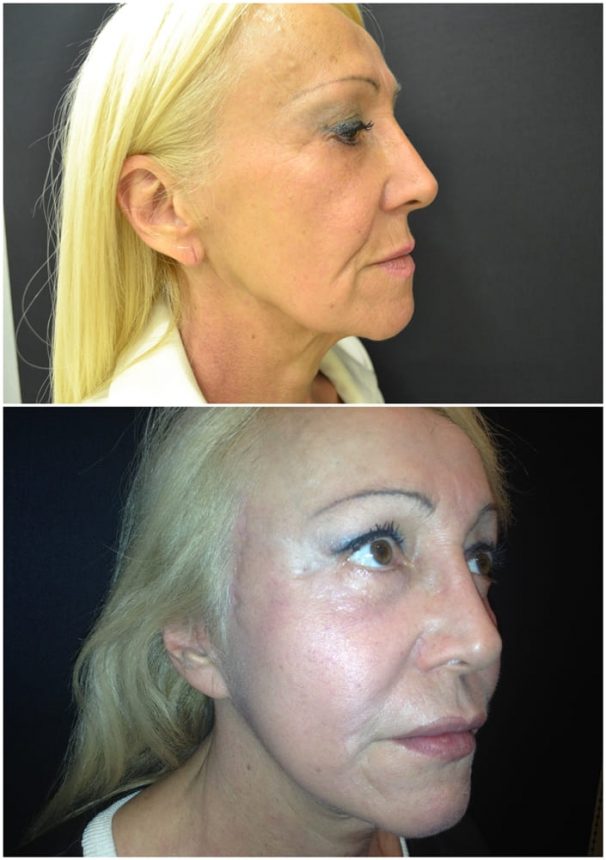 Lifting Viso e Collo Prima e Dopo