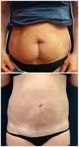 Liposuzione Addome Fianchi Prima Dopo foto risultati lipo pancia girovita