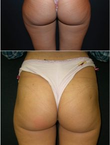 Liposuzione cosce glutei Prima e Dopo