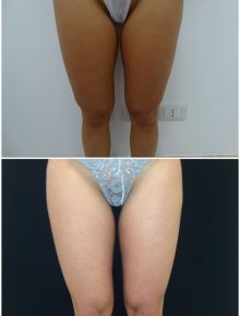 Liposuzione Gambe Prima e Dopo