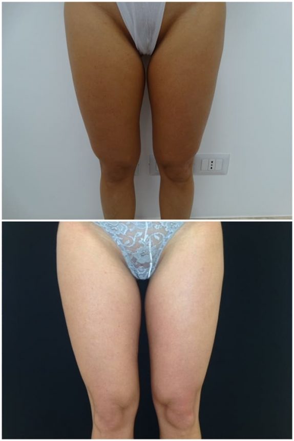 Liposuzione Gambe Prima e Dopo