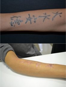 Laserterapia Laser Q-Switch Rimozione tatuaggi Prima e Dopo