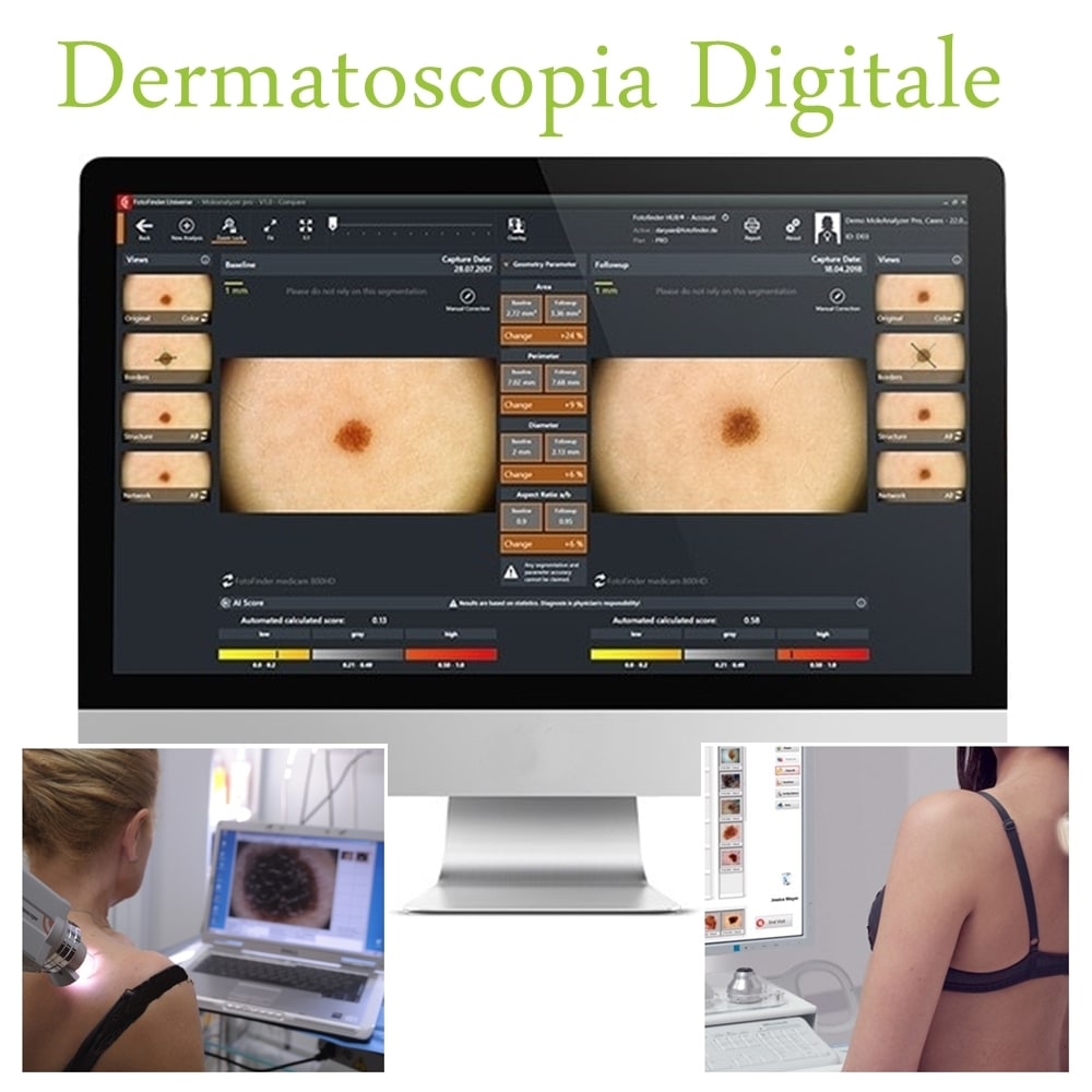 dermatoscopia digitale mappatura nei londeiclinic