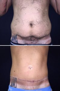 addominoplastica-uomo-prima-dopo-liposuzione-fianchi-uomo-foto-risultati