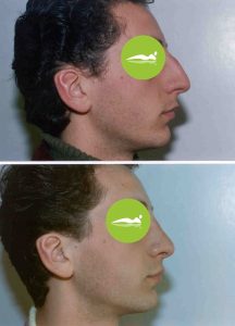 rinoplastica su paziente uomo foto prima dopo Rinoplastica uomo foto Prima Dopo
