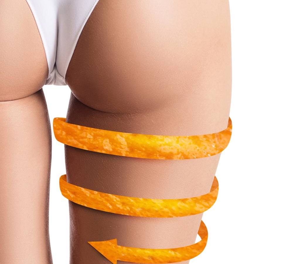 eliminare-cellulite-terapie