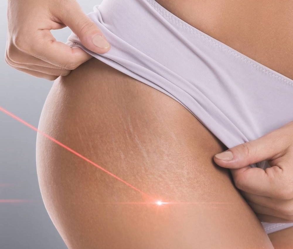 laserterapia-terapie-laser