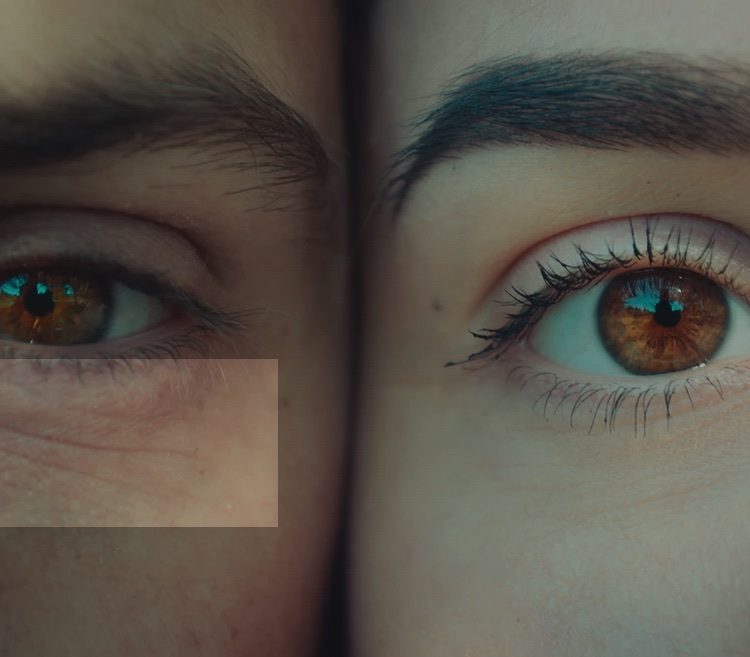 Blefaroplstica laser non chirurgica