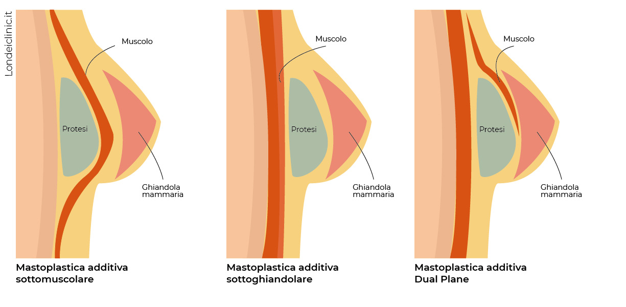 mastoplastica additiva