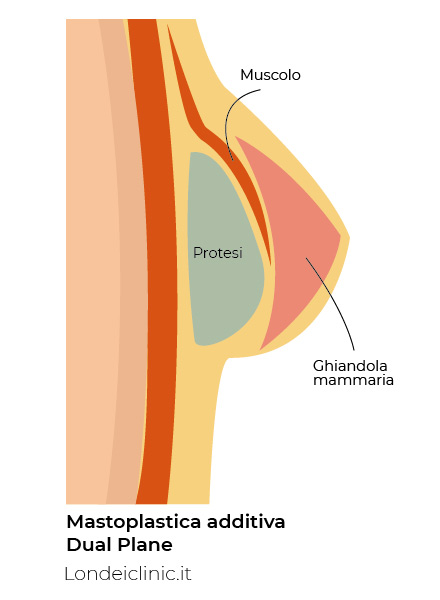 Mastoplastica additiva Dual Plane