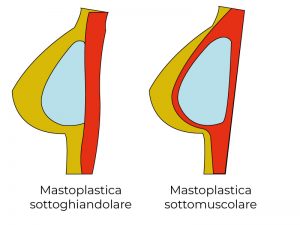 mastoplastica sottomuscolare