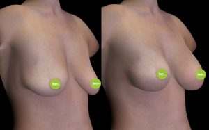 Simulazione 3D mastoplastica additiva protesi 270 cc LondeiClinic