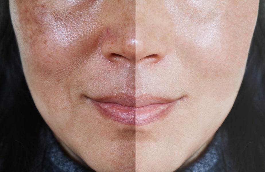 dermamelan trattamento peeling per eliminare melasma prima dopo