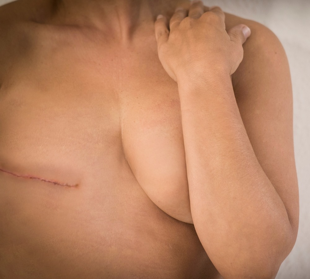 Protesi capezzolo ricostruzione mammaria post mastectomia