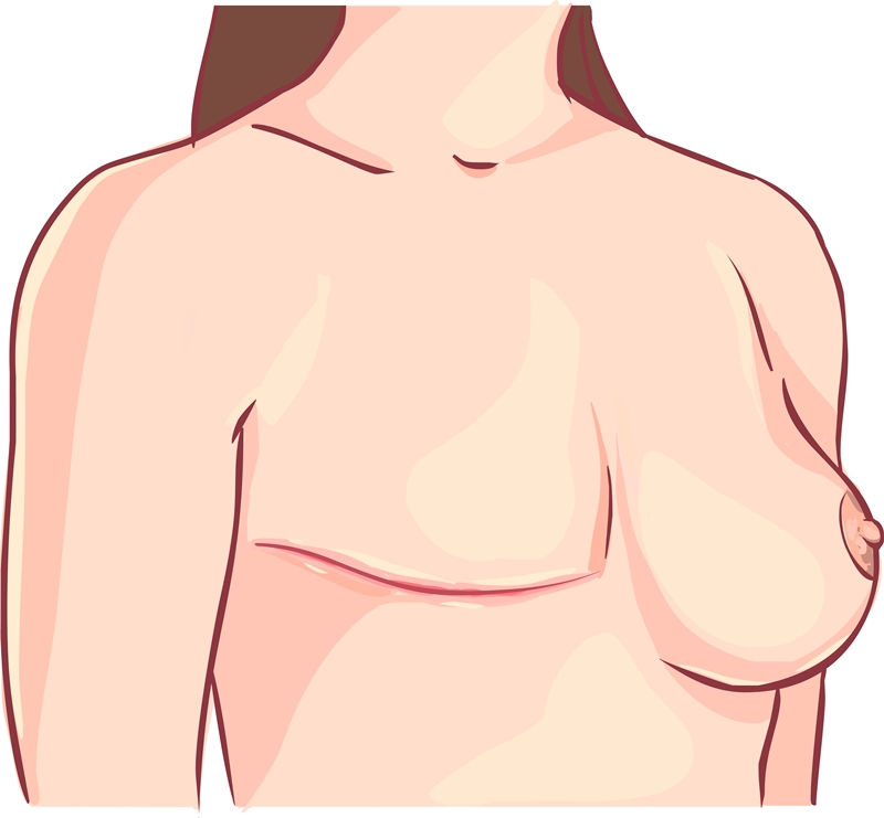 mastectomia illustrazione protesi capezzolo per ricostruzione mammaria
