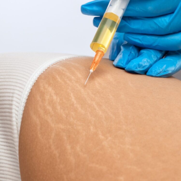 nanofat smagliature riempimento con grasso londeiclinic padova cagliari